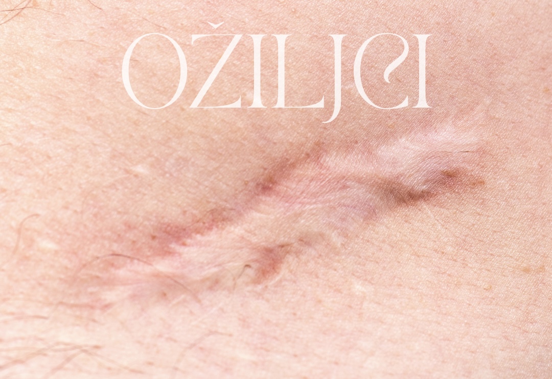Ožiljci — Crystalia tretmani
